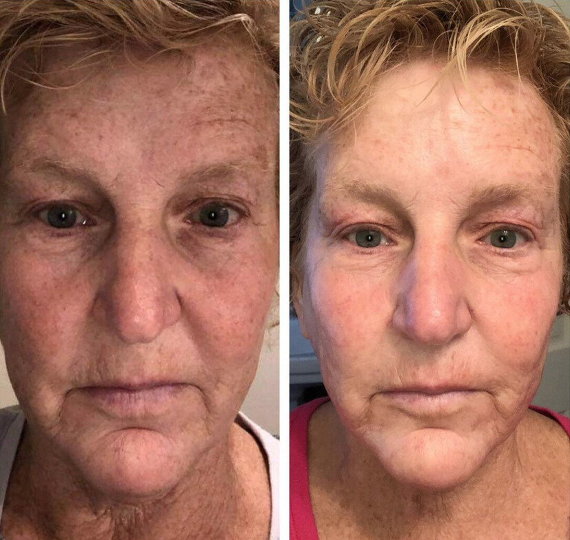 NeoGen Face Rejuvination Repair