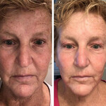 NeoGen Face Rejuvination Repair