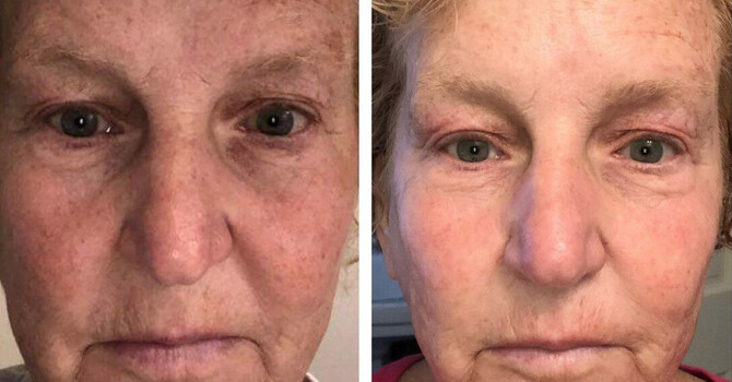 Neogen Laser Coming soon image