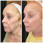 NeoGen Plasma Rejuvination