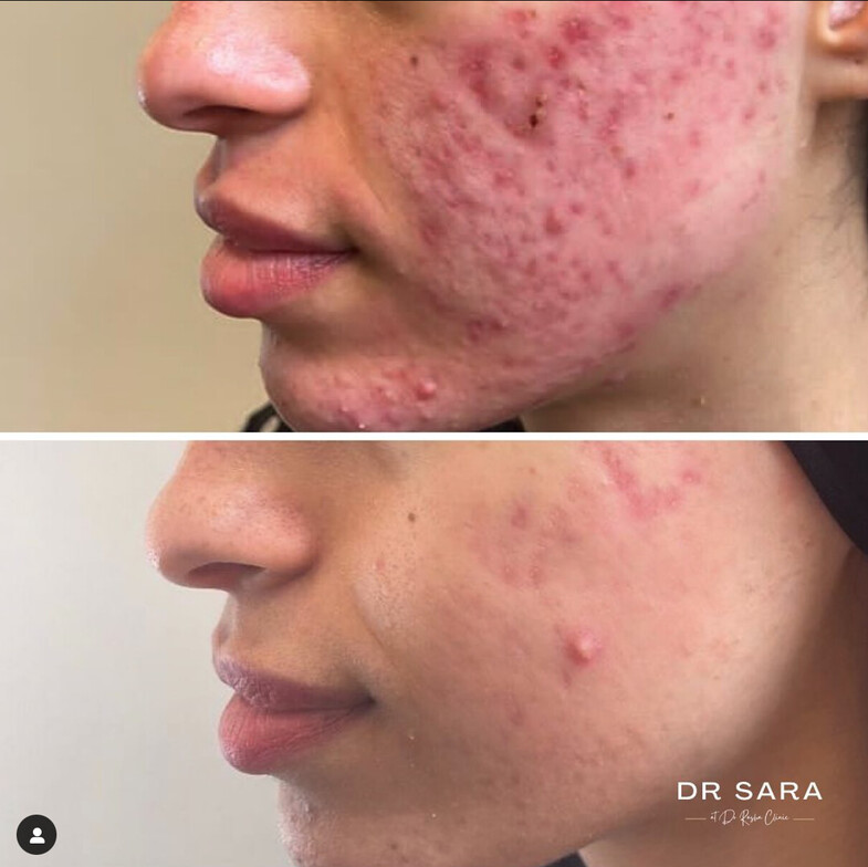 NeoGen Acne Repair